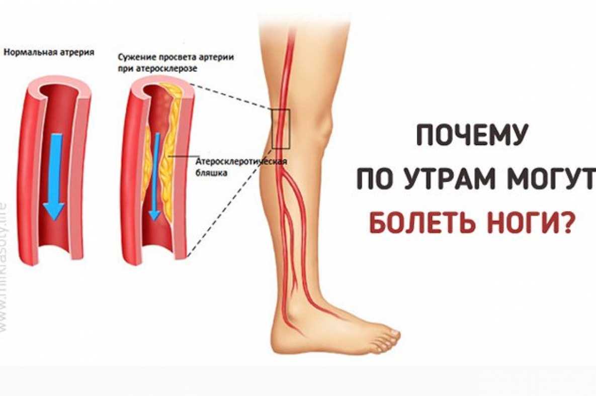 Болят ноги после коронавируса | причины боли мышц после ковида